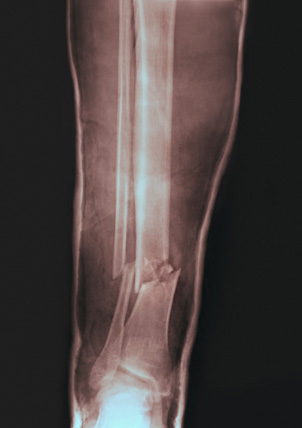 Fractured Leg